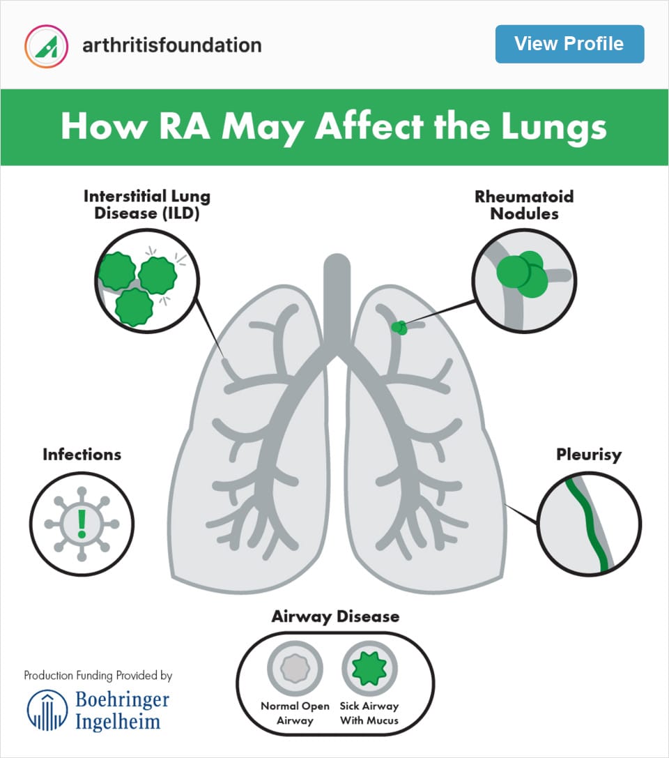 Follow Arthritis Foundation's Instagram Account