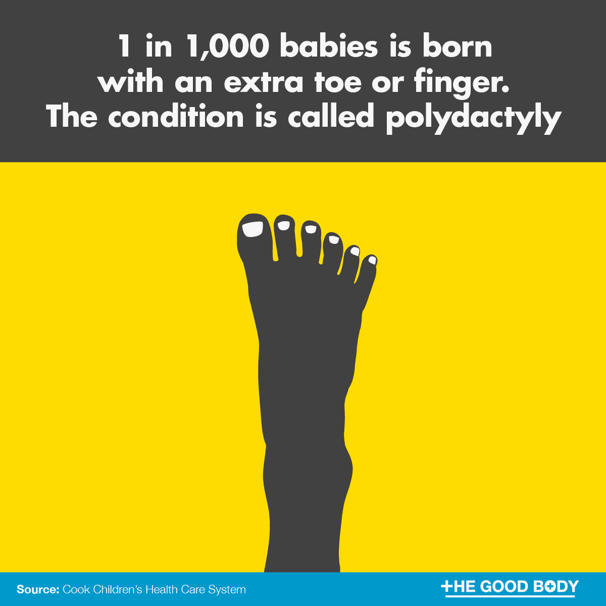 1 in 1,000 babies is born with an extra toe or finger. The condition is called polydactyly