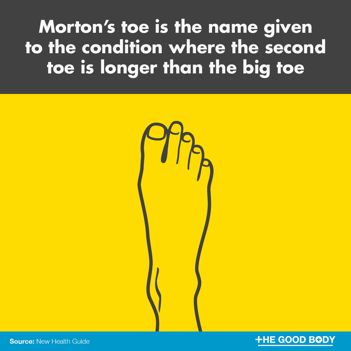 Morton’s toe is the name given to the condition where the second toe is longer than the big toe